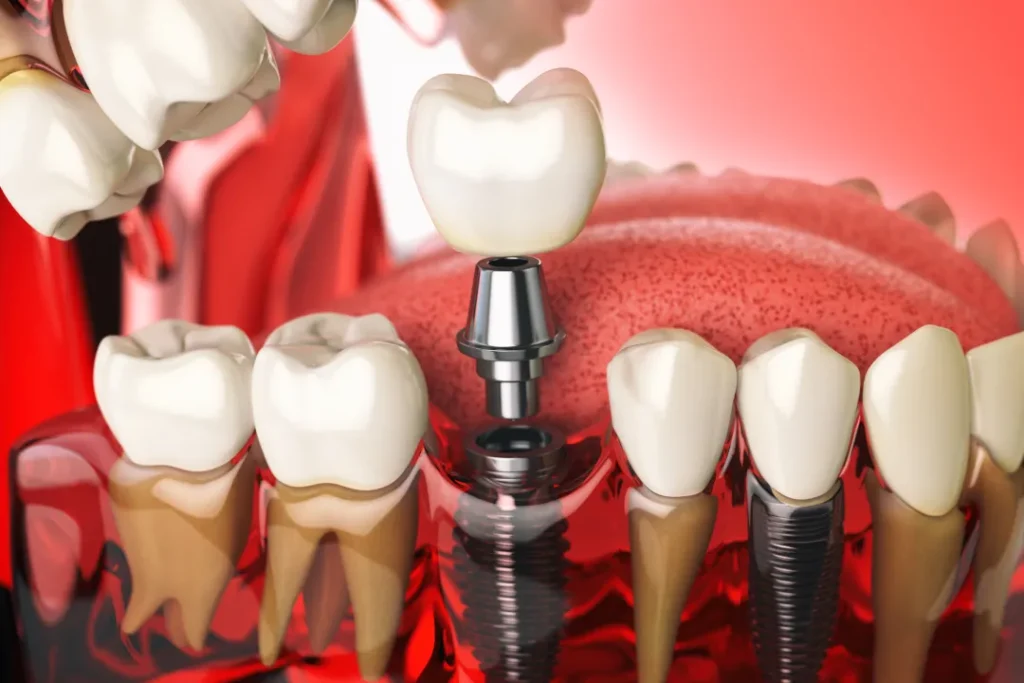 Learn How Modern Permanent Dental Implants Can Restore Your Smile